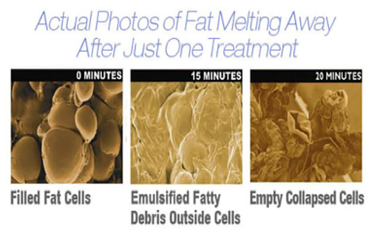 MaxLipo Light treatment in session